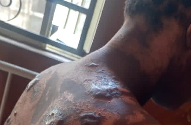 Akwa Ibom lady bathed with peppered hot water by her landlady, begs Soludo for help